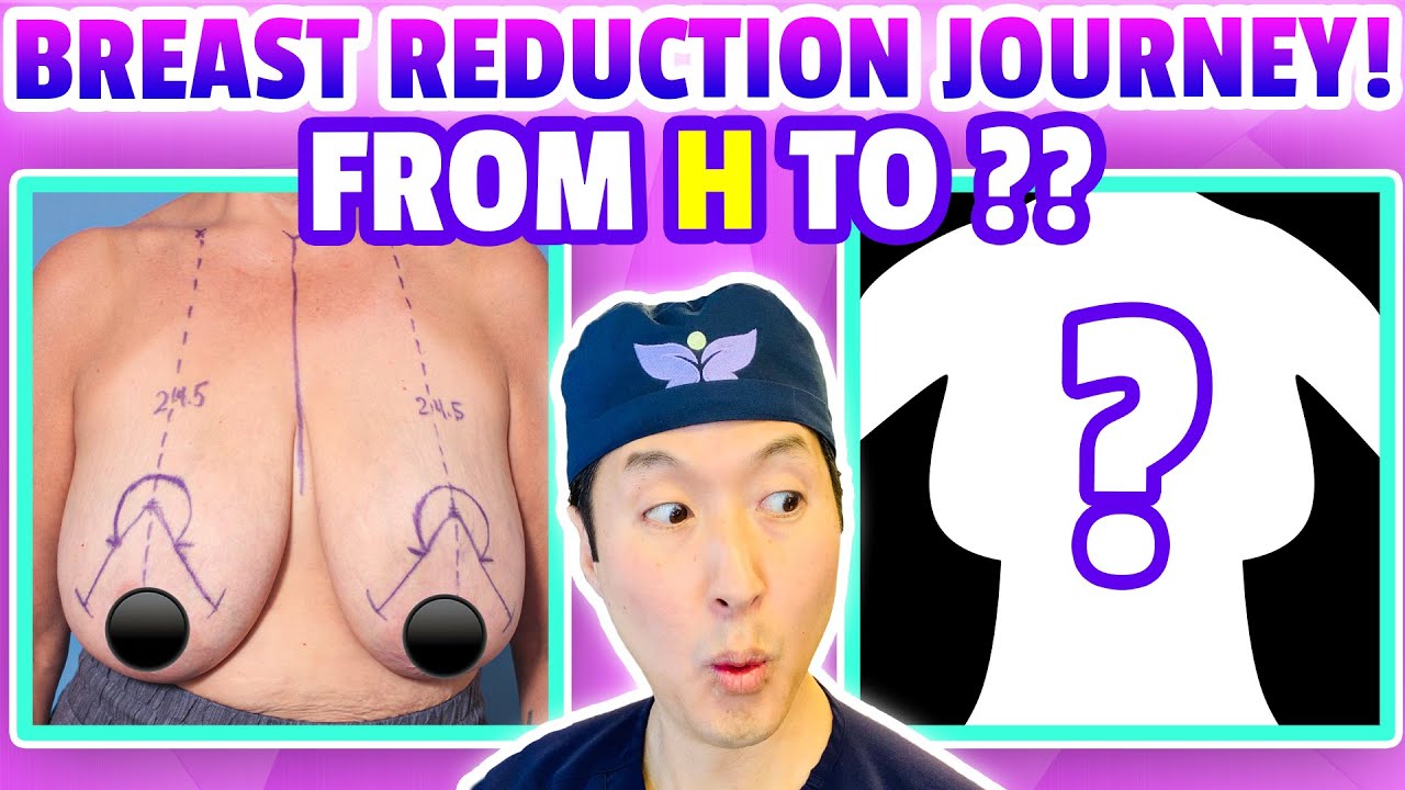 How She Went From an H Cup to a ?? One Woman's Breast Reduction Journey! -  Dr. Anthony Youn 