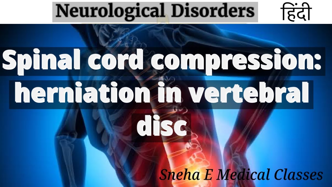Spinal cord compression herniation of vertebral disc !! Medical