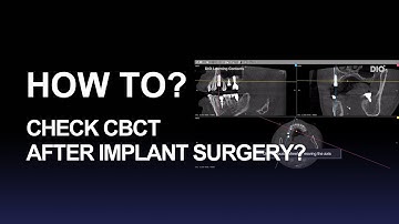 How to check CBCT after implant surgery?