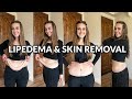 Loose Skin Removal &amp; Lipedema Treatment After 200+ Pounds Weight Loss