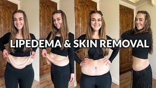 Loose Skin Removal & Lipedema Treatment After 200+ Pounds Weight Loss