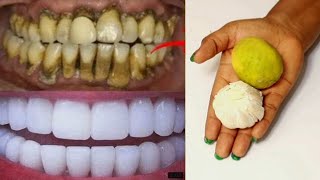 REMOVE DENTAL PLAQUE AT HOME IN 2 MINUTES WITHOUT VISITING THE DENTIST