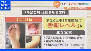 すでに“警報レベル！”全国各地で、子どもたちが感染する「手足口病」。 患者数は去年の10倍！新型コロナと同時に感染も…｜TBS NEWS DIG