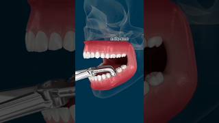 What Happens If You Don’t Replace a Lost Tooth? 😱   #dental  #teeth  #dentalanimation  #shorts