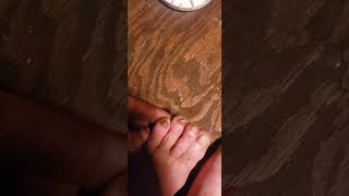 Thick Toenails Fungus GOOP is the Answer