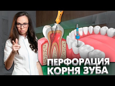 Перфорация корня зуба.
