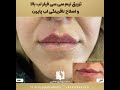 تزریق ژل لب در شیراز توسط دکتر مهسا پور هاشمی