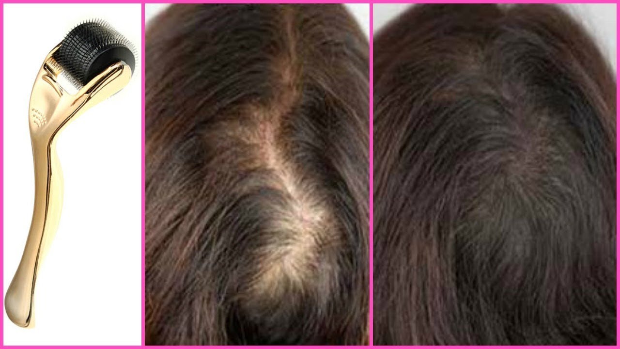 Image result for Derma Needling Hair for Loss