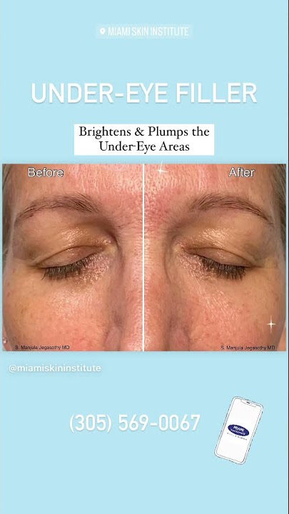 Fix Your Hollow, Dark Under Eye Circles