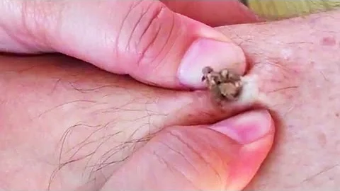 Dilated Pore of Winer (Giant Blackhead!)
