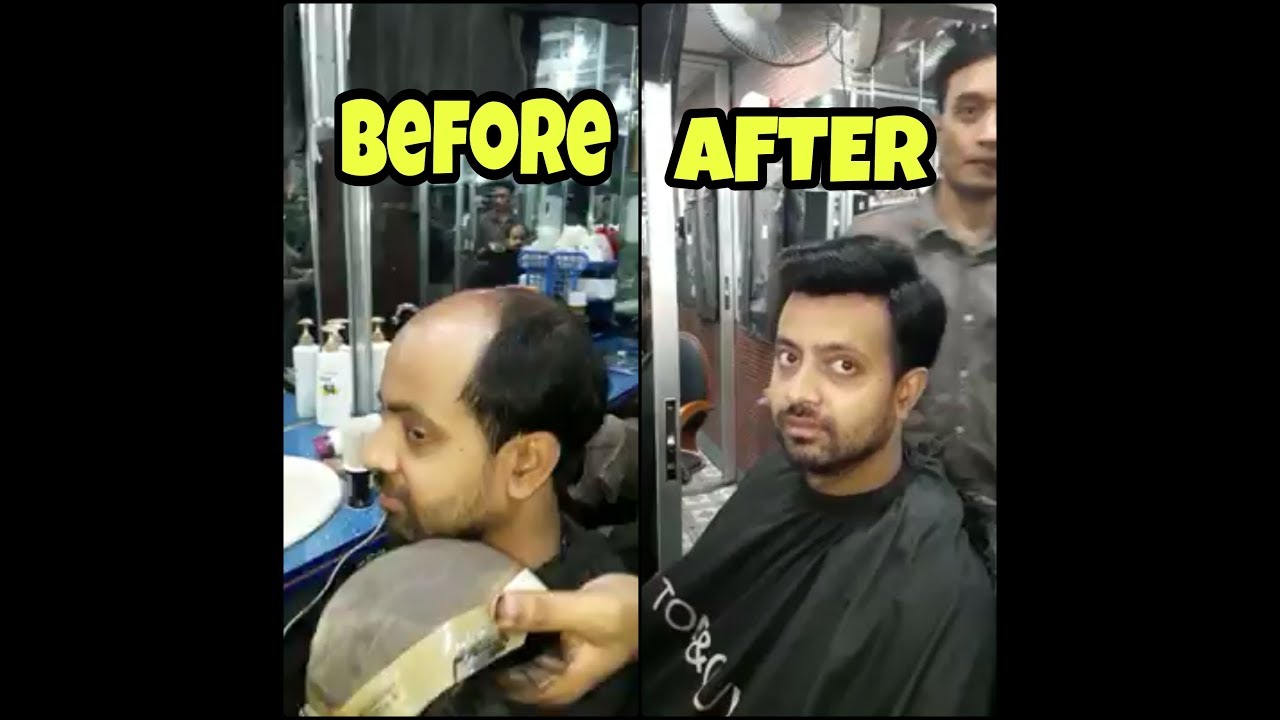 Hair wig transplant.. YouTube