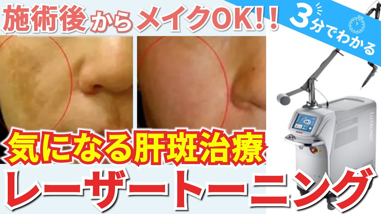 肝斑レーザートーニングで治らない人（3分でわかる）