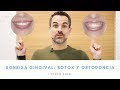 TOOTH BOSS || La sonrisa gingival: botox y ortodoncia || Ortodoncia en Murcia