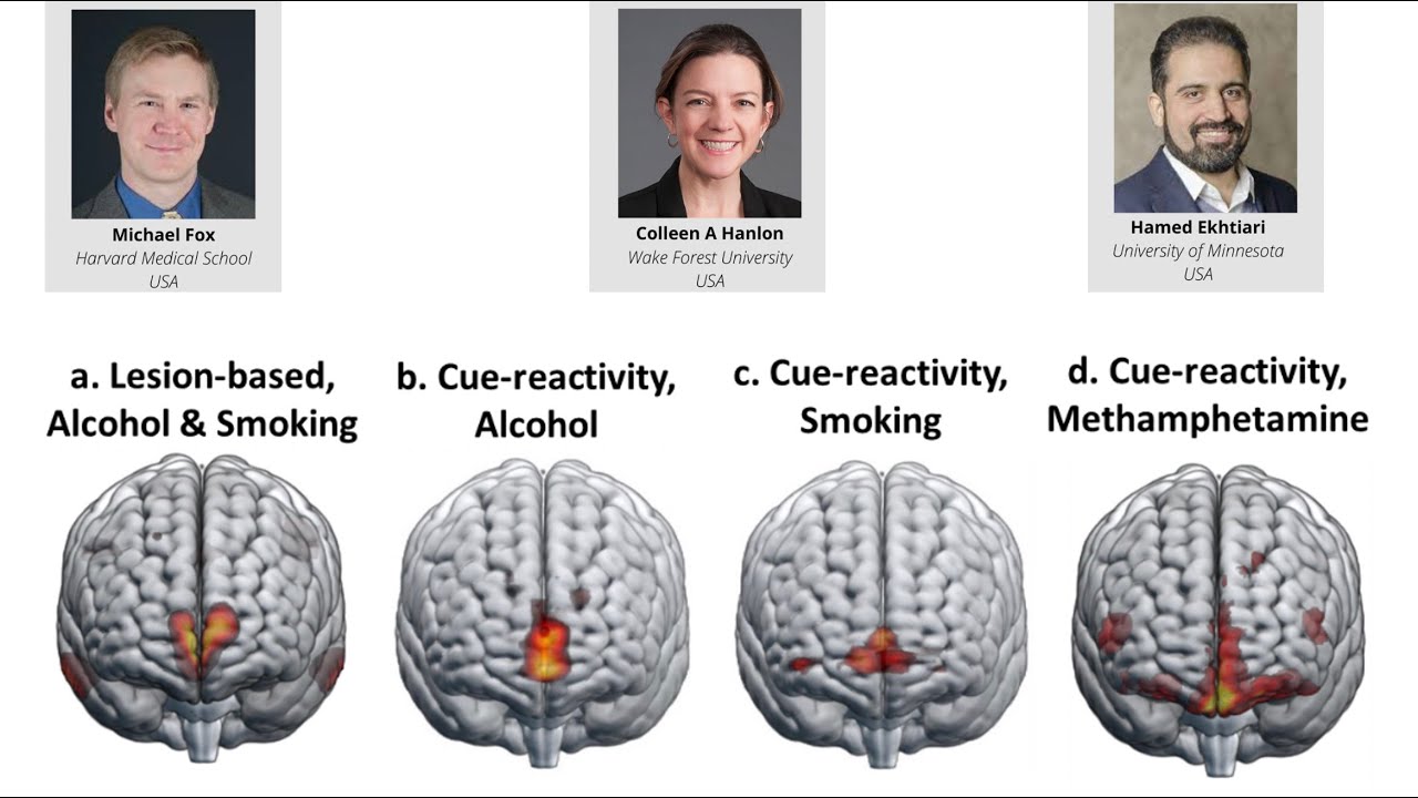 Addiction Treatment with Brain Stimulation: Hopes and Challenges, UMN Psychiatry, Grand Round, 2023