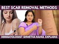கையில இருக்க Scar-அ மறைக்க Best Tips இதான்! - Dr Shwetha Rahul Explains | Scar Removal Method