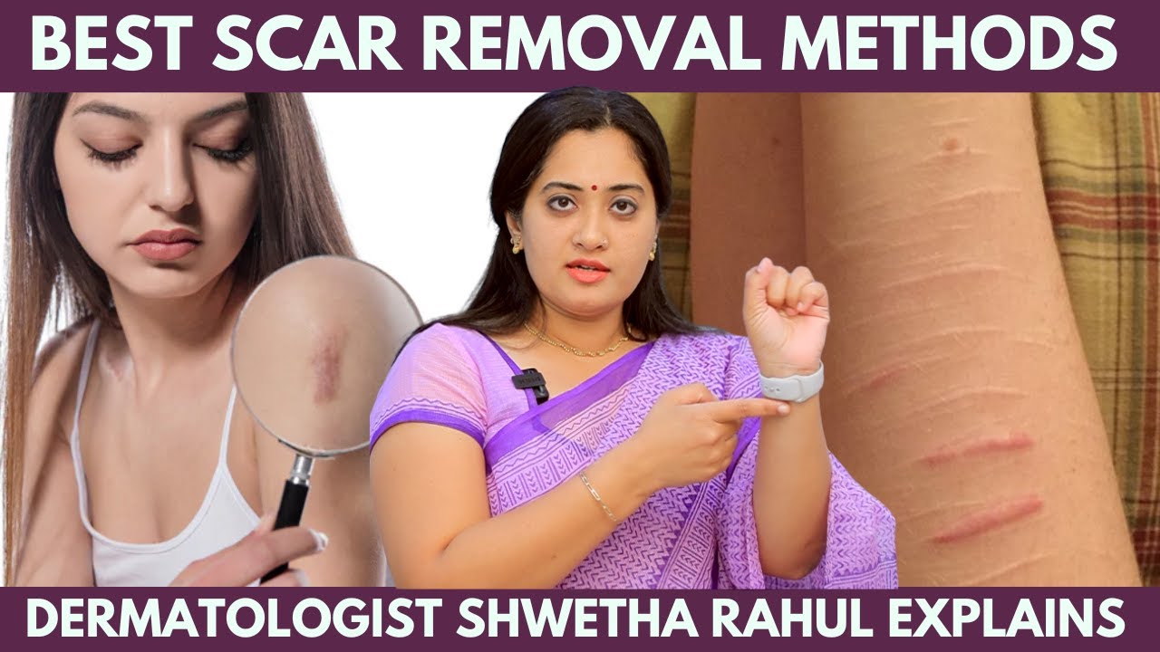 கையில இருக்க Scar-அ மறைக்க Best Tips இதான்! - Dr Shwetha Rahul Explains | Scar Removal Method