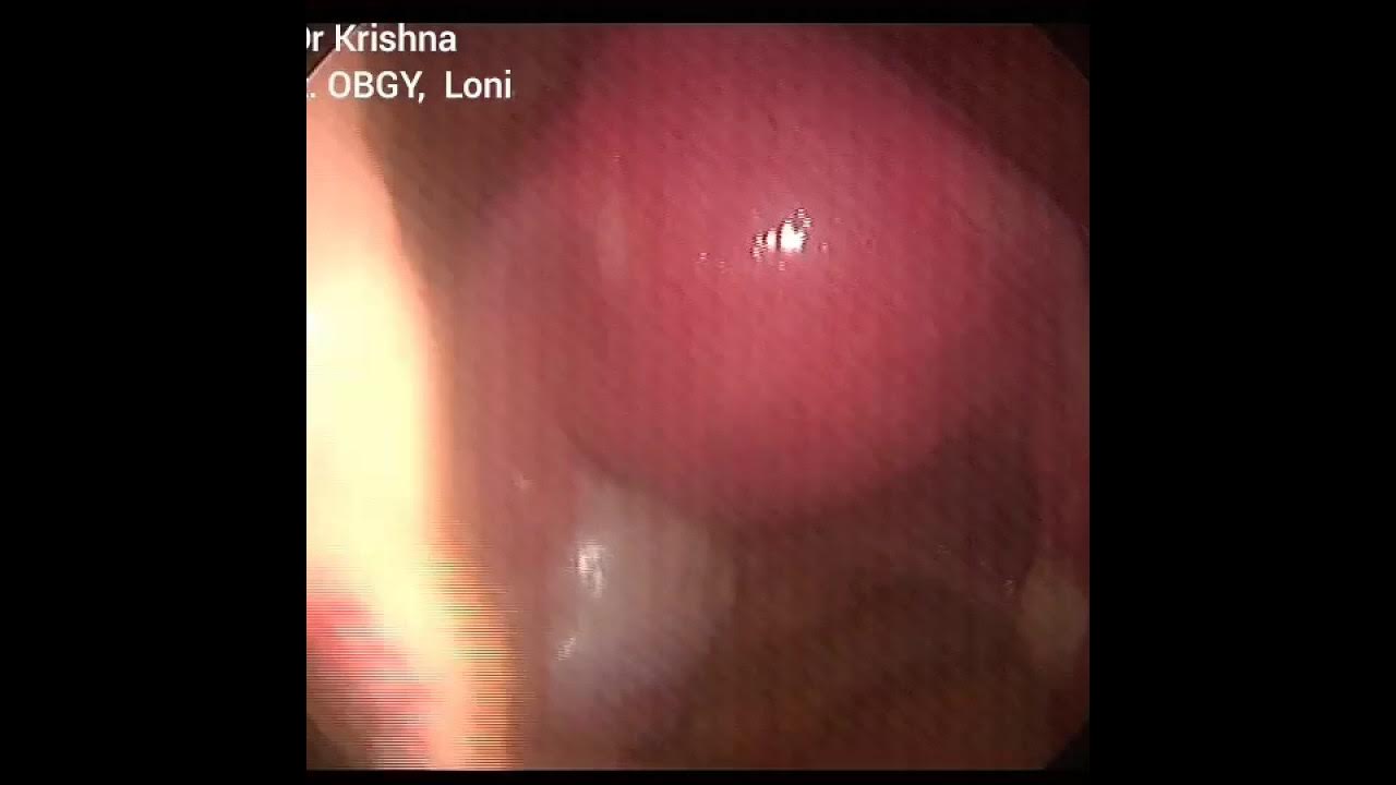 Simple laparoscopic sterilization YouTube