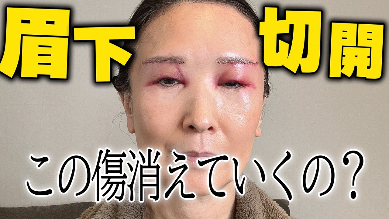 眼瞼下垂症で悩んでいる方に見てほしい動画です。
