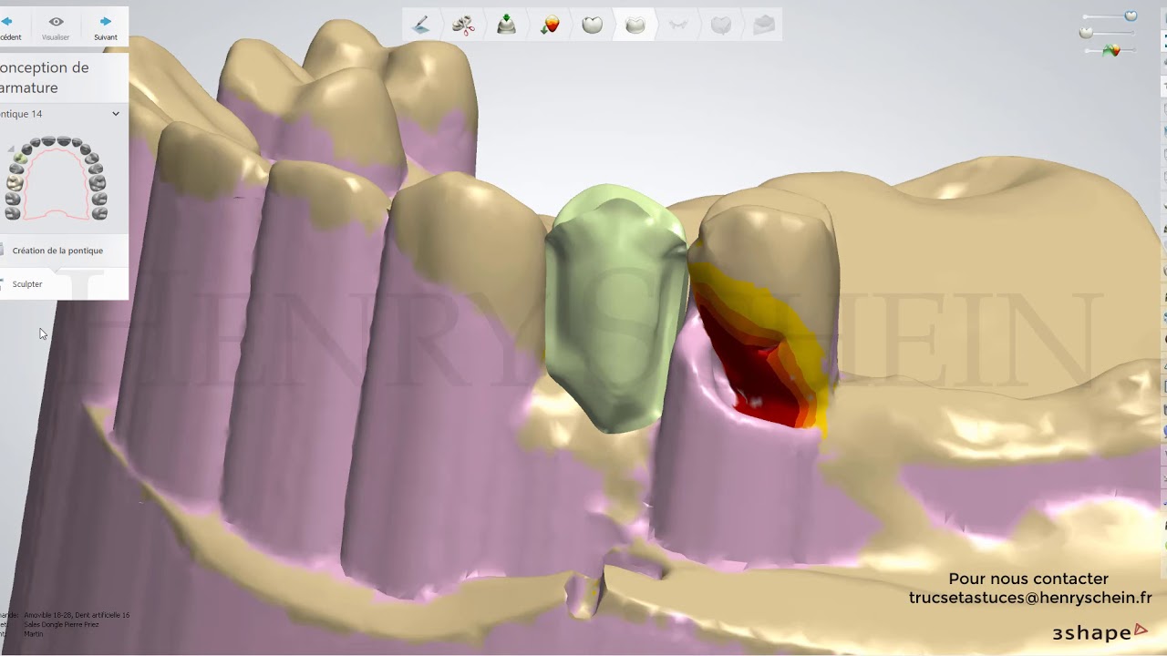 Stellite Dents massives et contre plaquées