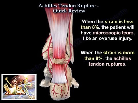 Achilles Tendon Rupture Quick Review - Everything You Need To Know - Dr. Nabil Ebraheim