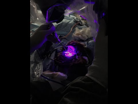 თავის ტვინის სიმსივნეების ქირურგიული მკურნალობა ინტრაოპერაციული ფლუოროსკოპიის გამოყენებით