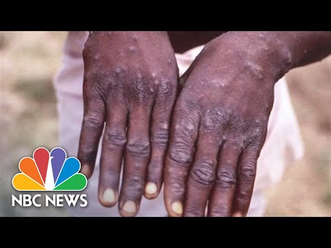 WHO Warns Monkeypox Must Be Contained Before It Becomes Global Issue