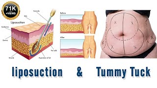 Liposuction For Weight Loss, Surgery Cost, Procedure, Side Effects, Tummy Tuck Abdominoplasty