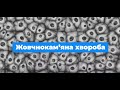 Жовчнокам’яна хвороба і холецистит. Джанелідзе Д.Т.