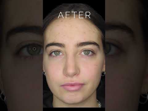 Video thumbnail: Before & After Nose Job: Dorsal Hump & Bulbous Tip #nosejobbeforeandafter #nosejobs · Dr. Anthony Corrado