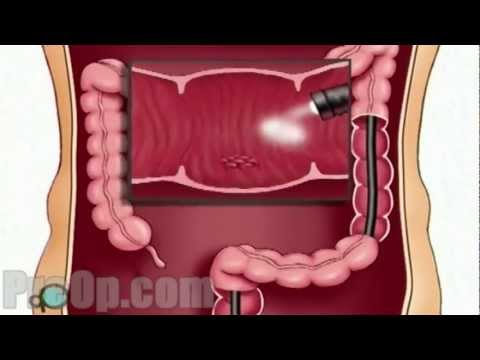 Endoscopy of Large Intestine Surgery - Patient Education HD