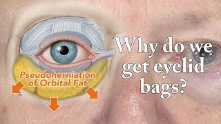 How Eyelid Bags Appear - Anatomy | Aesthetic Minutes #Shorts #EyelidBags