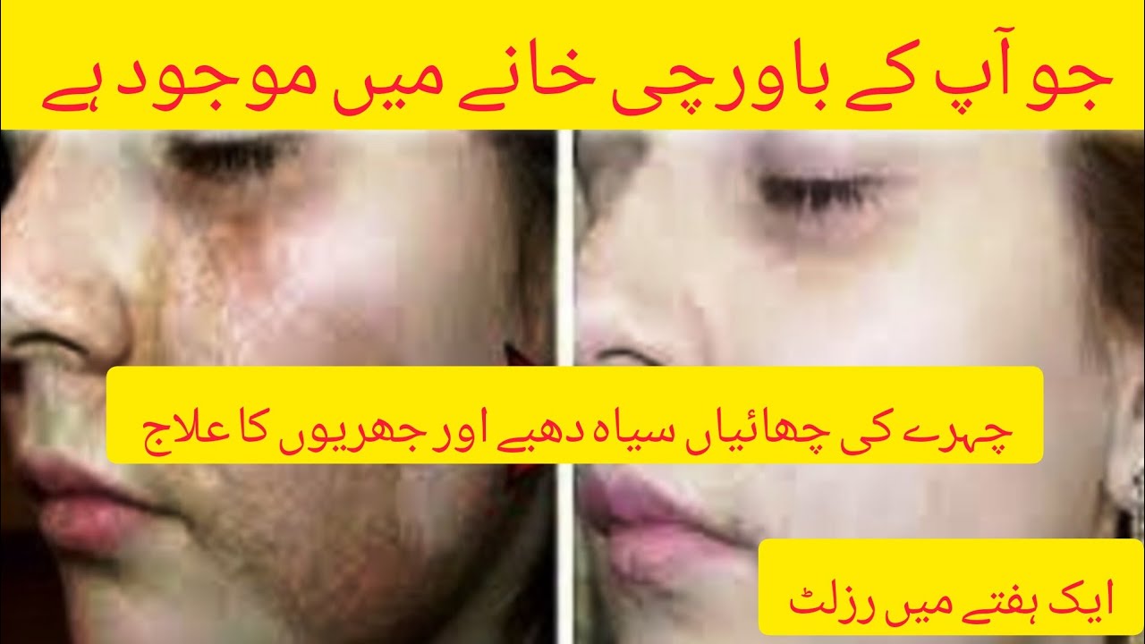 Chehre ki chhaya saiya dhaabe aur jhuriyon ka ilaj1 hafte mein result