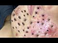 Blackhead Removal With Sac Dep Spa @10006894