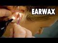 PAINFUL EARWAX REMOVAL (2 Huge Clumps) | Dr. Paul