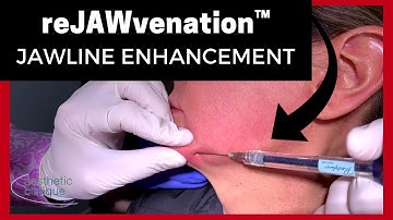 reJAWvenation™ Jawline Filler using Restylane Defyne by reJAWvenator, Dr. Steven F. Weiner Destin FL