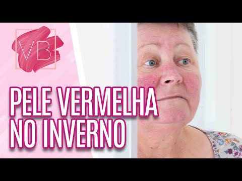 Vídeo: Como curar a pele queimada pelo vento?