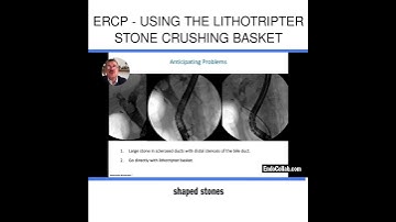 ERCP - Using the Lithotripter Stone Crushing Basket