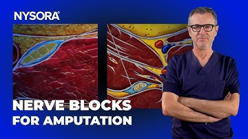 Sciatic + Femoral Nerve Blocks for AKA Amputation