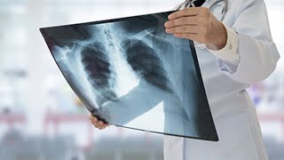 Should You Get an Annual Lung Cancer Screening? New Guidelines Expand Eligibility
