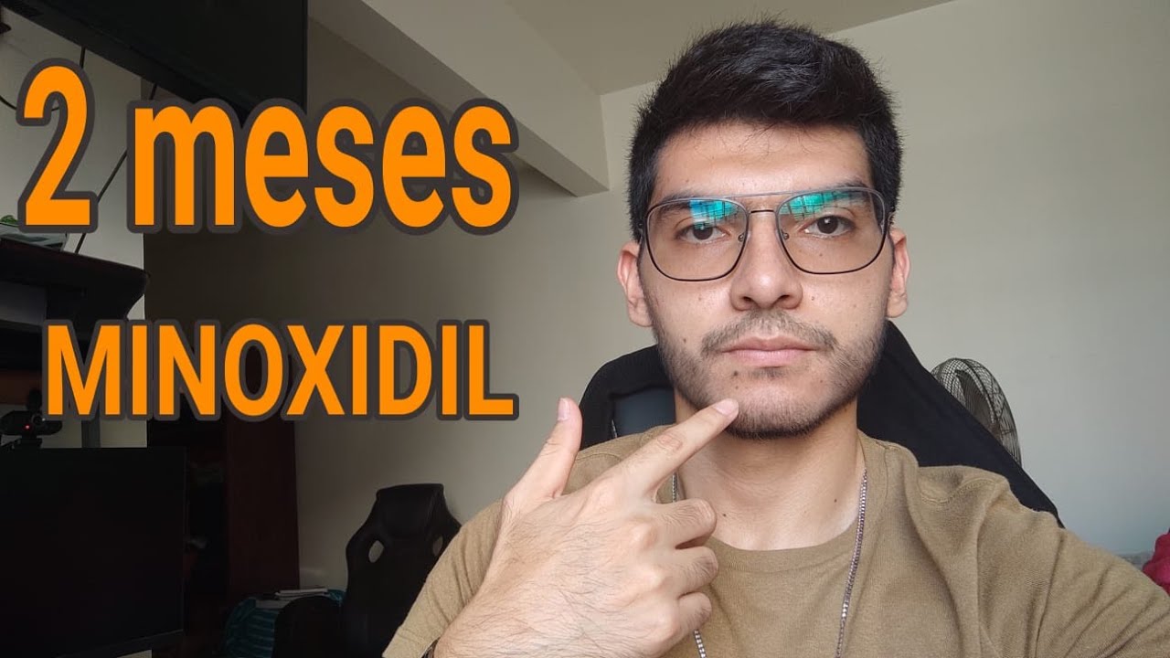 USANDO MINOXIDIL POR 2 MESES Paulino L pez YouTube