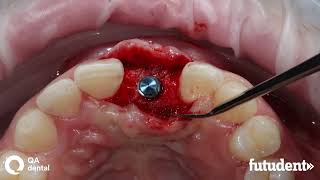 Implantation in maxillary anterior region (2/2) screenshot 3