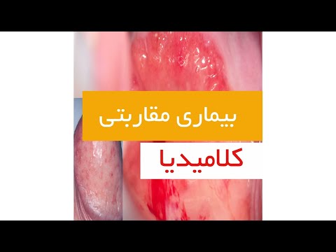 بیماری مقاربتی کلامیدیا - دکتر سید امین میرصادقی