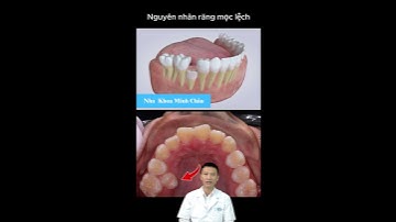Tình Trạng Răng Lệch Lạc Và Kẹt | Bác Sĩ Yên