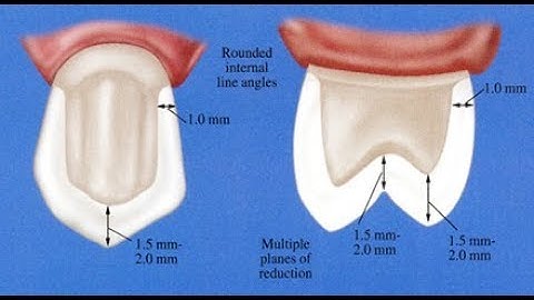 Hướng dẫn mài cùi răng cối nhỏ hàm trên