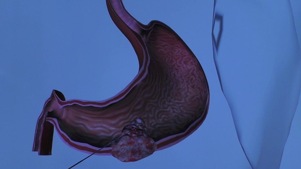 Understanding Stomach Cancer