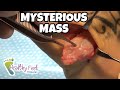 WATCH THE EXCITING MOMENT WHEN A GIANT MASS IS REMOVED FROM THE FOOT! WHAT'S INSIDE THE HUGE MASS!