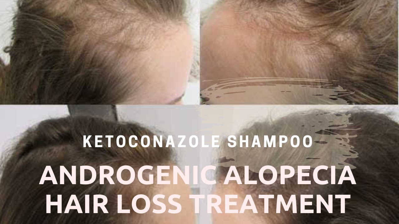 Androgenic Alopecia Hair Loss Treatment Ketoconazole Shampoo YouTube Androgenic Alopecia Hair Loss Treatment Ketoconazole Shampoo YouTube