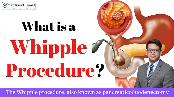 The Whipple Procedure | Pancreatic Cancer Surgery ...