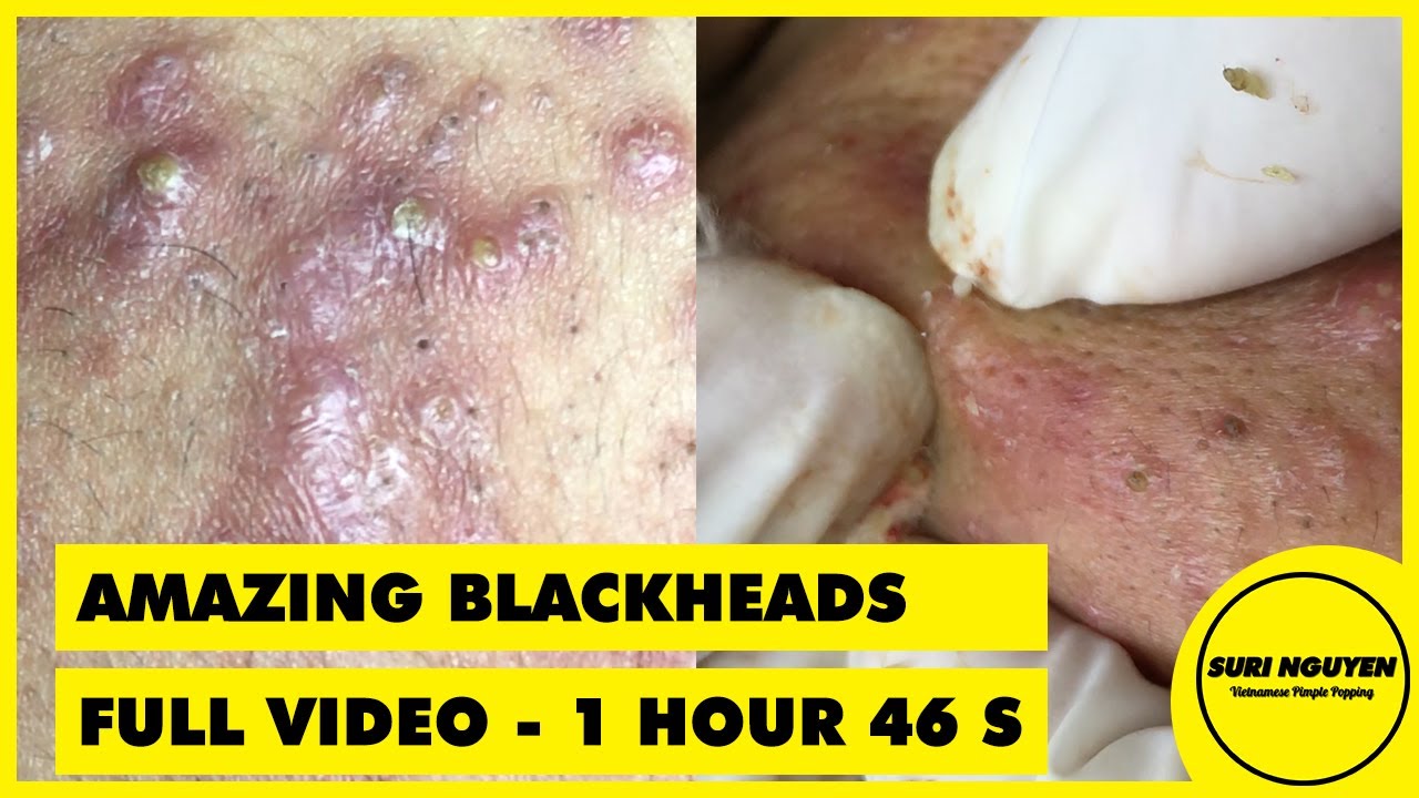Full Video [1hour 46s]: AMAZING INFLAMED BLACKHEADS POPPING