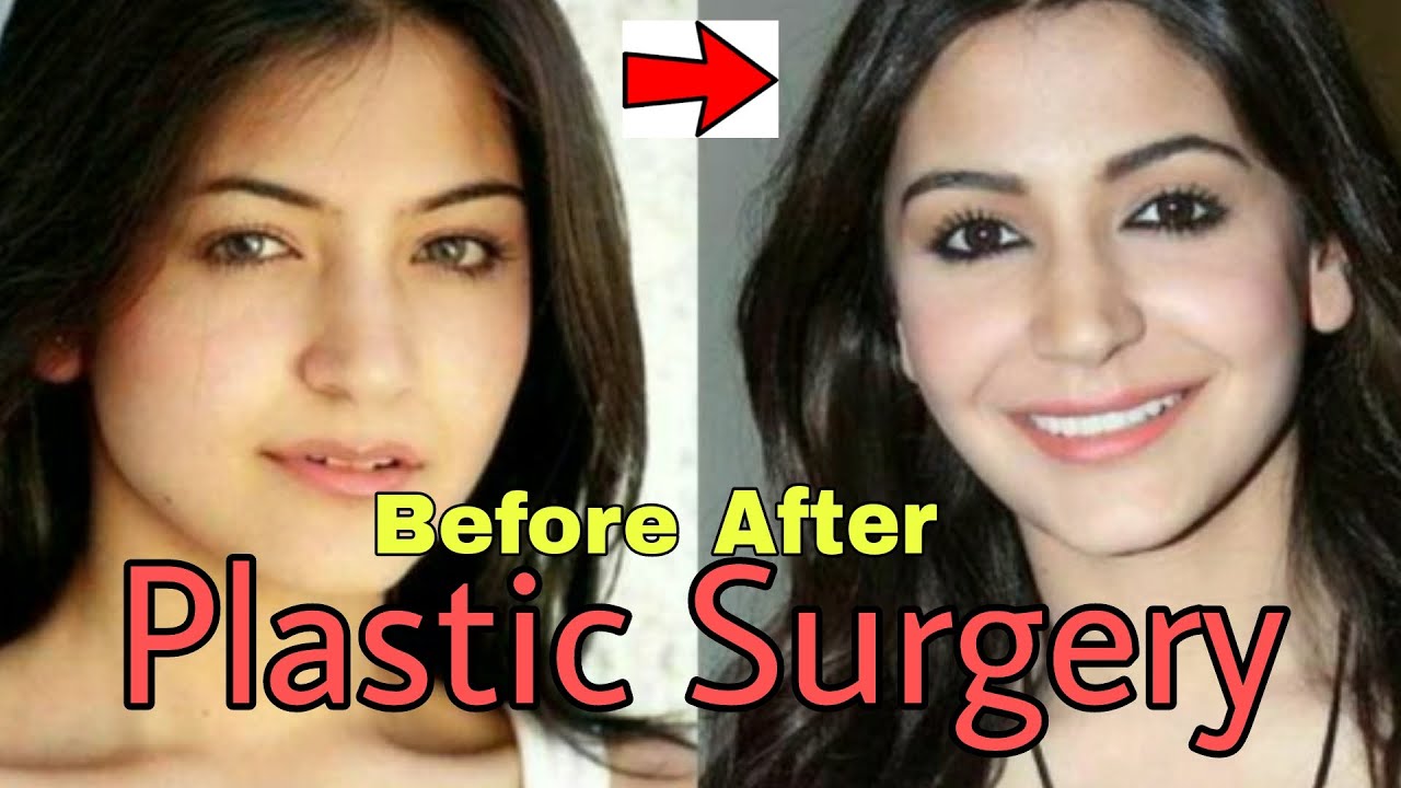 8 Popular Bollywood Actress Plastic Surgery Photos(Before/After)-SpotLight TV